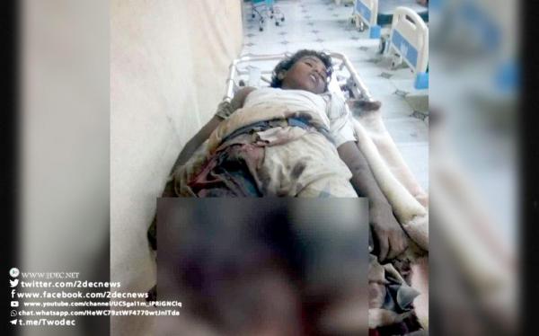 استشهاد طفل بلغم حوثي في مدينة الحديدة