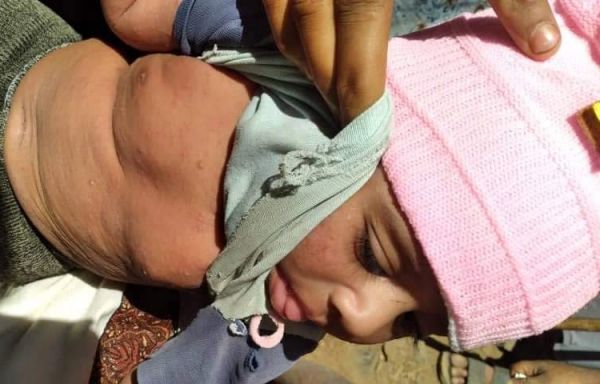 فيما تمنع المليشيا حملات التحصين.. الحصبة الألمانية تفتك بسكان المحابشة في حجة 