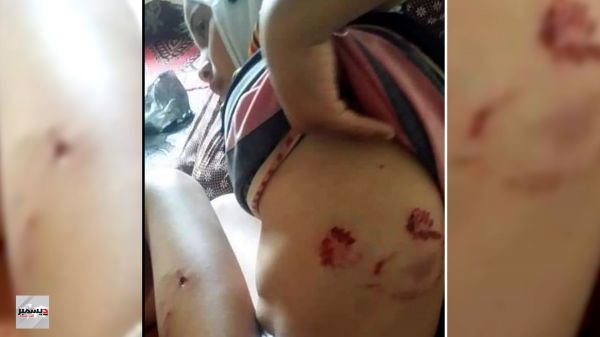 صورة| اليمنيون بين فكي كماشة.. نهب الحوثيين ونهش الكلاب