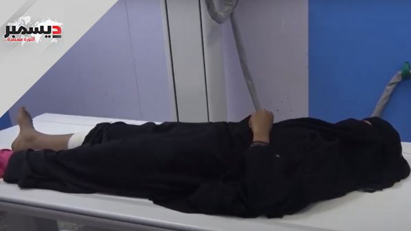إصابة امرأة في حيس برصاص قناصة المليشيا الحوثية