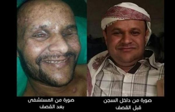 قصة مختطف.. ترفض مليشيات الحوثي الإفراج عنه رغم إصابته البالغة