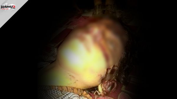 قاومت مغتصبها الحوثي فهشم رأسها وسجن والدها.. الطفلة «مرام» قصة تختزل حكاية وطن