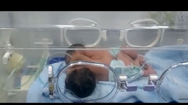 الملك سلمان يوجه بنقل التوأم السيامي اليمني "مودة ورحمة" للرياض    