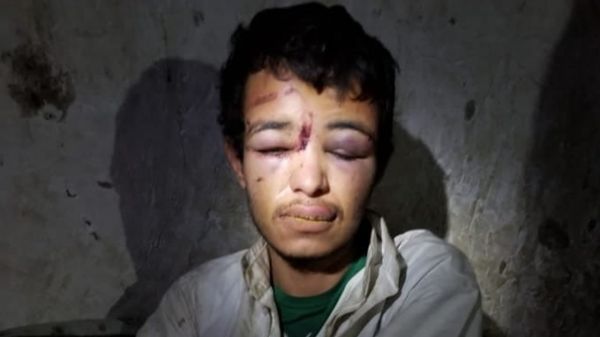 صورة | رجع من الجوف مصدقا "عفو السيد".. تعذيب الحوثيين لأحد العائدين أفقده عقله