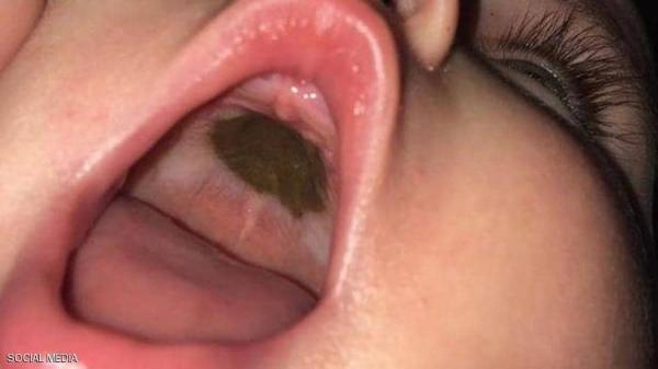 ما سر هذه البقعة السوداء في فم الطفلة؟