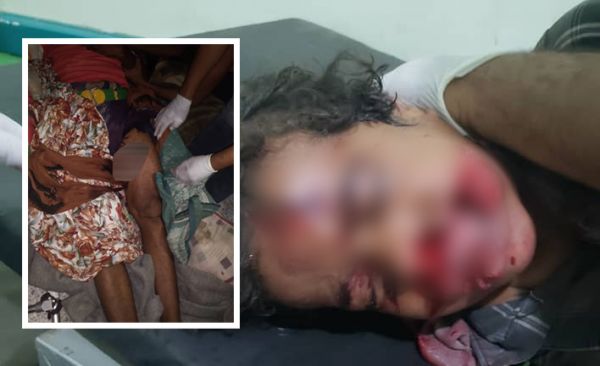 صور| إصابة مدني وأحد أطفاله بمقذوف حوثي غربي تعز 
