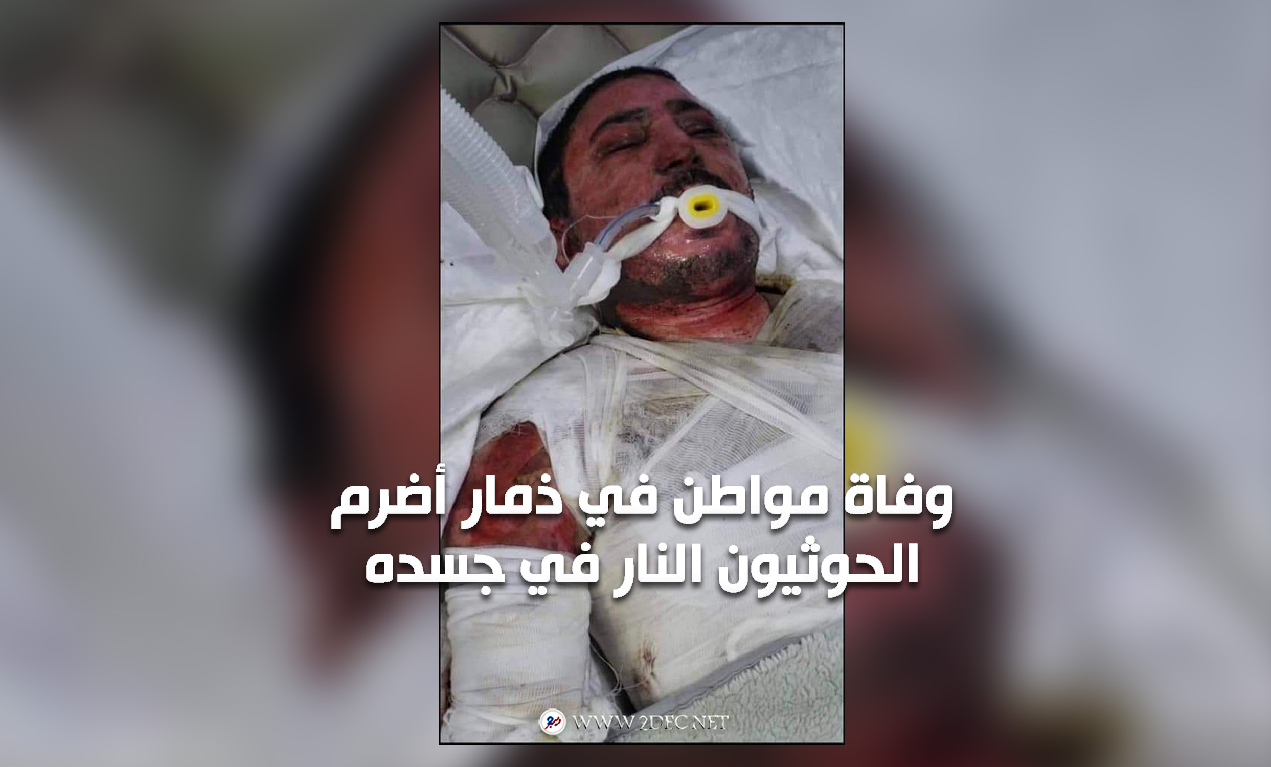وفاة مواطن في ذمار أضرم الحوثيون النار في جسده 