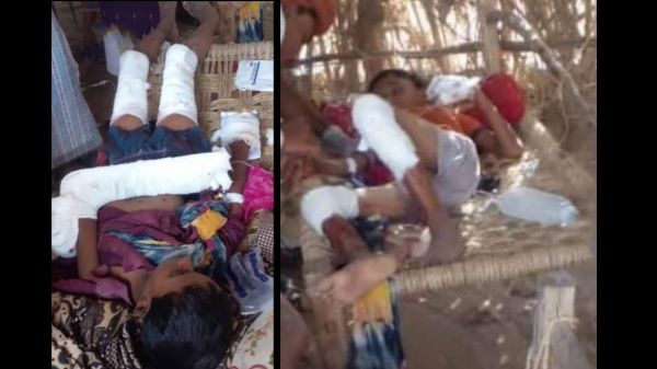 استشهاد طفل وإصابة آخر بلغم حوثي جنوبي الحديدة 