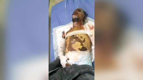 مواطن في إب يضرم النار في جسده احتجاجا على انعدام الخدمات