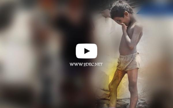 فيديو جرافيك| لغم حوثي يكبل الطفل عمران بإعاقة مدى الحياة