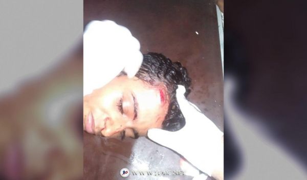 رصاصة قناص حوثي تصيب طفلا برأسه أثناء سيره لأداء الصلاة في حيس
