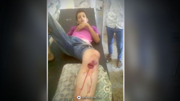 الضالع: مصابون مدنيون بينهم طفل إثر انفجار مخلفات حرب حوثية 