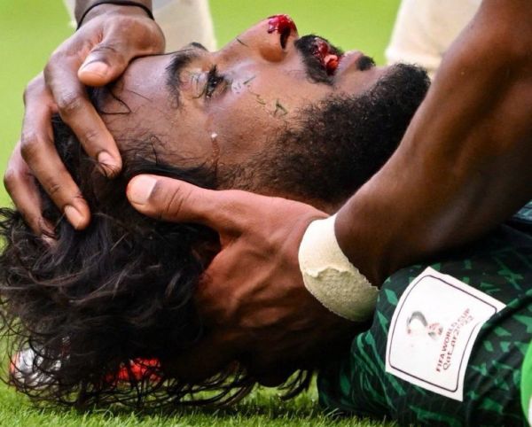 مصدر طبي في بعثة المنتخب السعودي : إصابة الشهراني خطيرة بحاجة لتدخل جراحي عاجل لإيقاف النزيف 