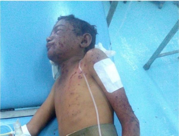 العميد طارق صالح يتكفل بعلاج طفل من أهالي مقبنة تعز أصيب بانفجار لغم حوثي (صورة)